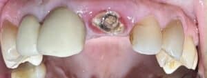 Extraction of Broken Tooth with Same Day Placement of Implant and Temporary Crown