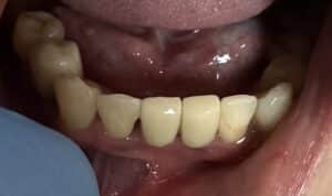 Immediate Placement of 2 Dental Implants after Extraction of Teeth in the Anterior Region of the Lower Jaw